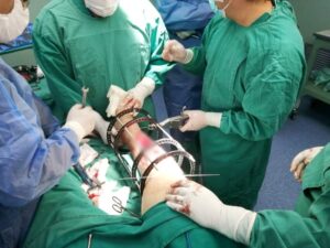 Médicos de Cusco alargan hueso de adulto mayor para evitar amputación de pierna
